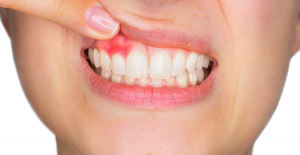 خراج الاسنان - Tooth abscess