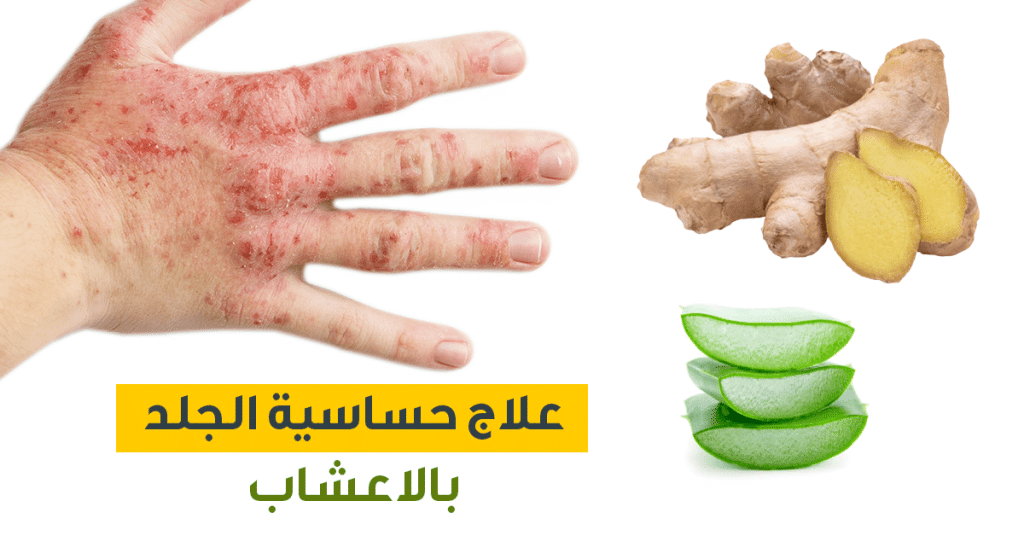 علاج حساسية الجلد بالأعشاب
